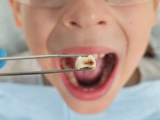 Best Emergency Treatment for Dental Infections or Abscesses in Hutto, TX